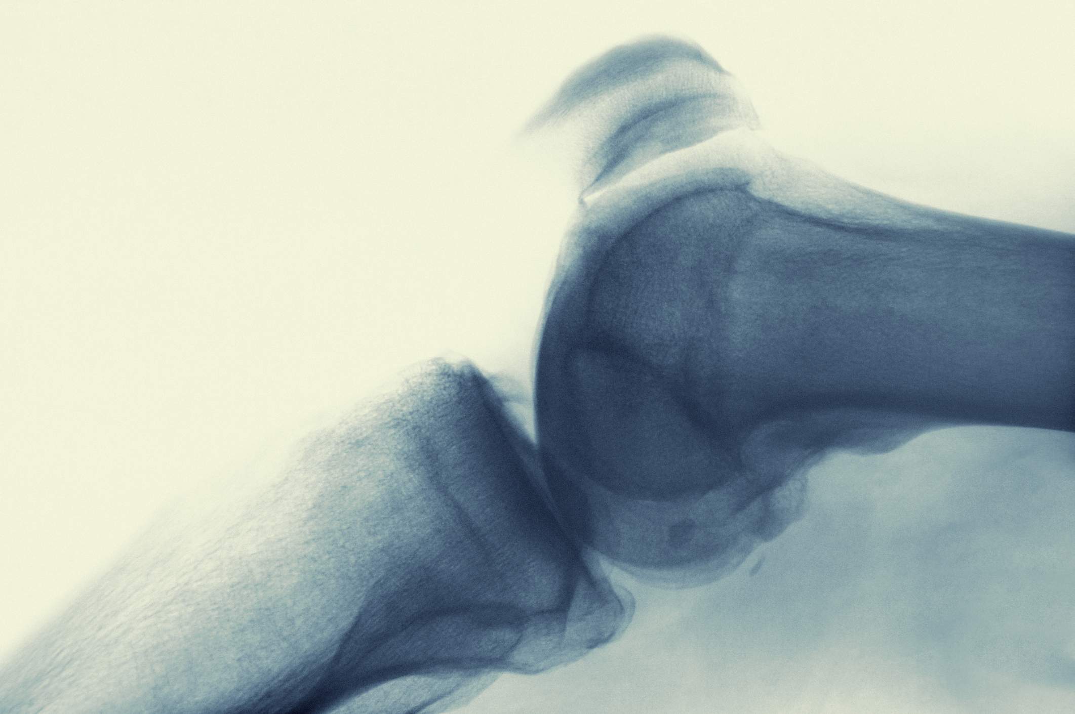Røntgen billede der viser slidgigt i knæ