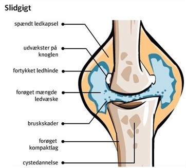 illustration af hvad der sker ved slidgigt i knæet