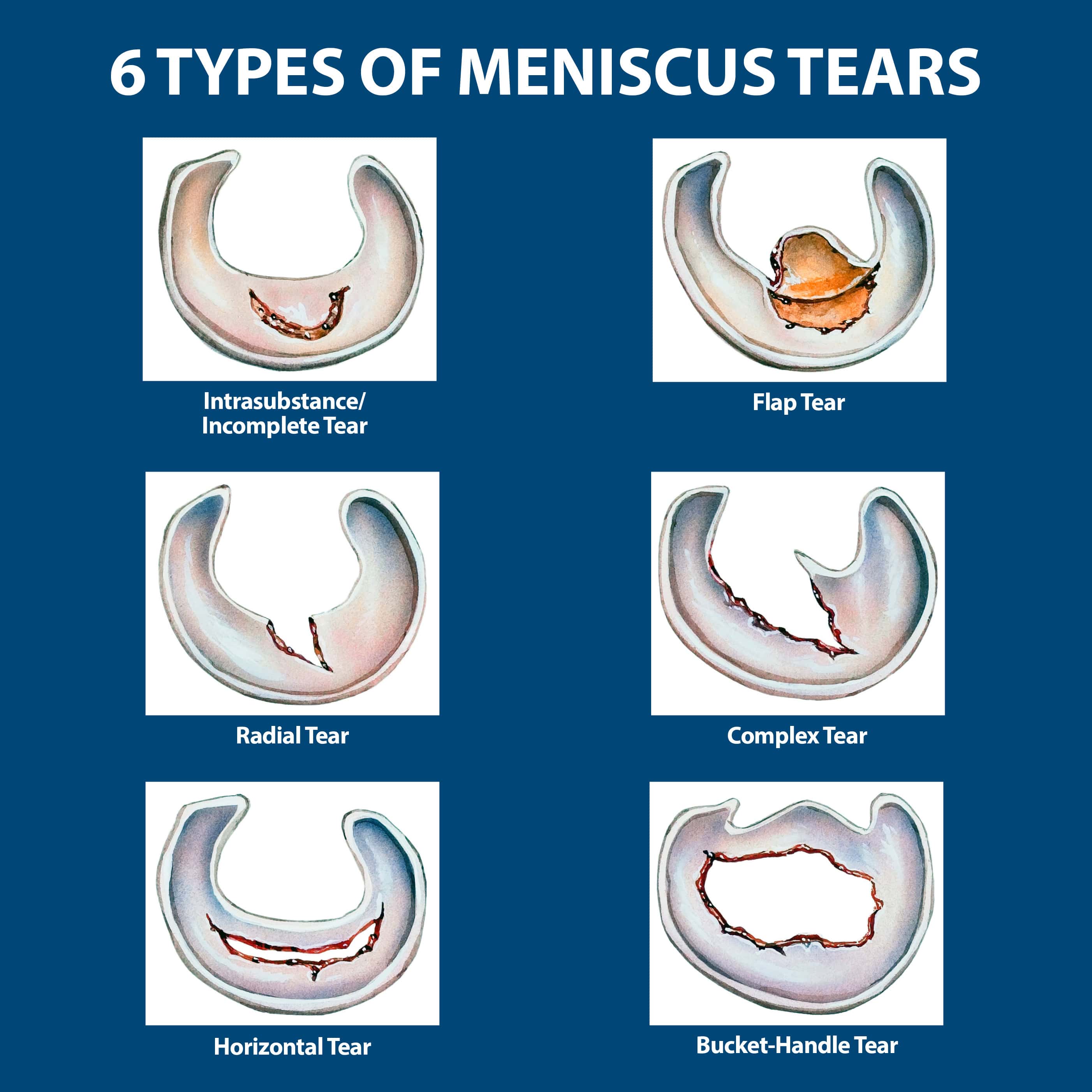 Meniscus-Tear-Graphicjpg